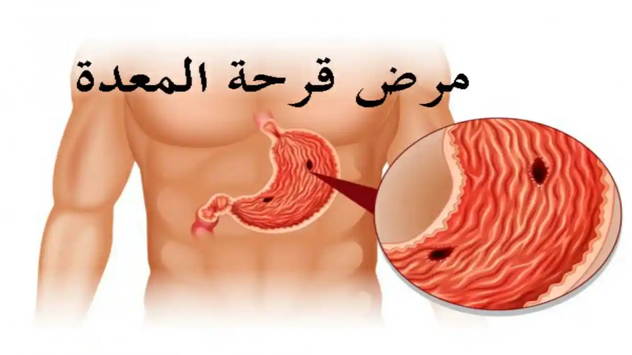 تجربتي في علاج قرحة المعدة