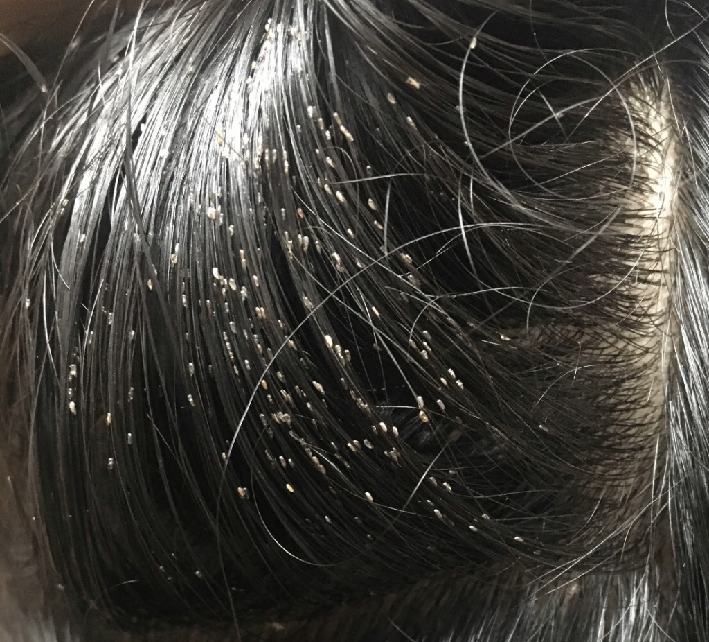 تفسير حلم رؤية القمل الابيض في المنام